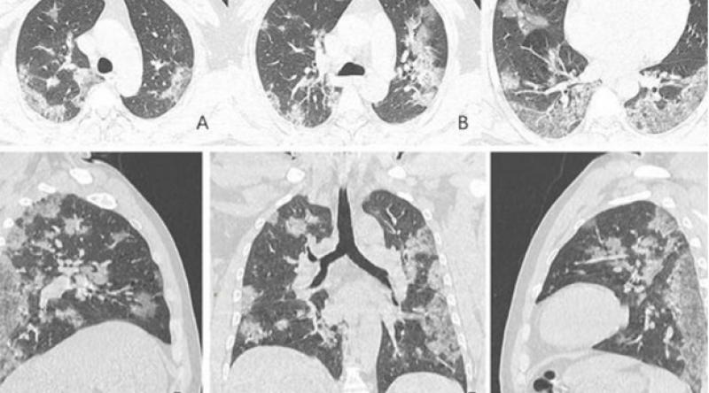 Koronavirüsten hayatını kaybeden kişinin akciğer röntgen filmleri paylaşıldı