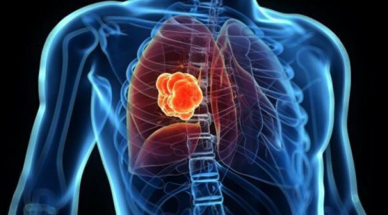 Akciğer kanserinin Türkiye’ye maliyeti 8,8 milyar TL