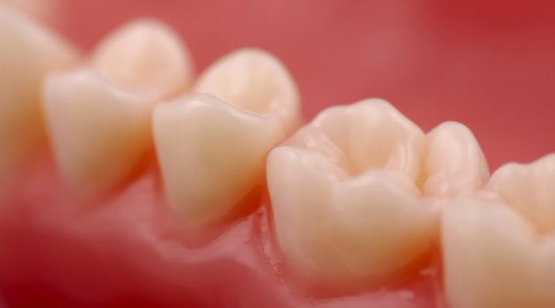 Diş Eti Çekilmesinin Nedenleri ve Tedavisi