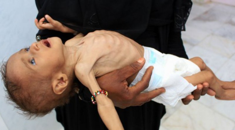 Yemen’de 100 binden fazla çocuk öldü